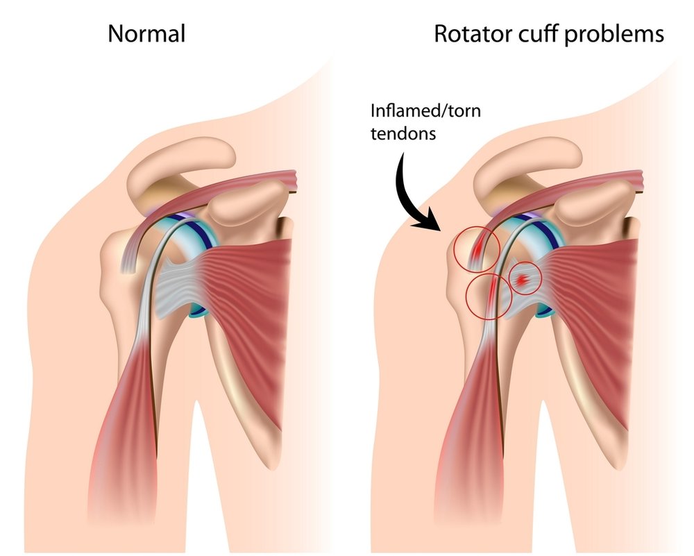 Shoulder Impingement Syndrome: The Complete Guide