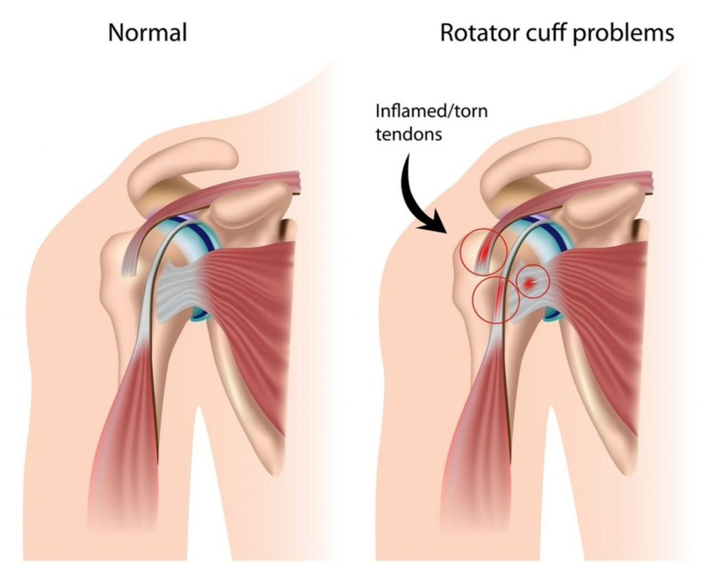 Screen Shot 2021-12-07 at 3.16.21 PM The Best Shoulder Pulley for Shoulder Pain
