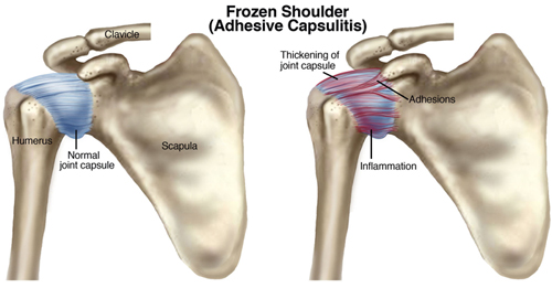 The Best Shoulder Pulley for Shoulder Pain